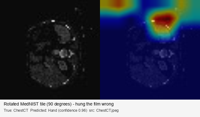 Augmentation-induced failure: rotated ChestCT confidently classified as a Hand, GradCAM heatmap on the empty corner